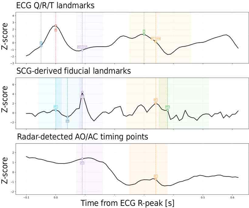 ECG R peak 기준 ECG SCG Radar landmark와 AO AC 후보
